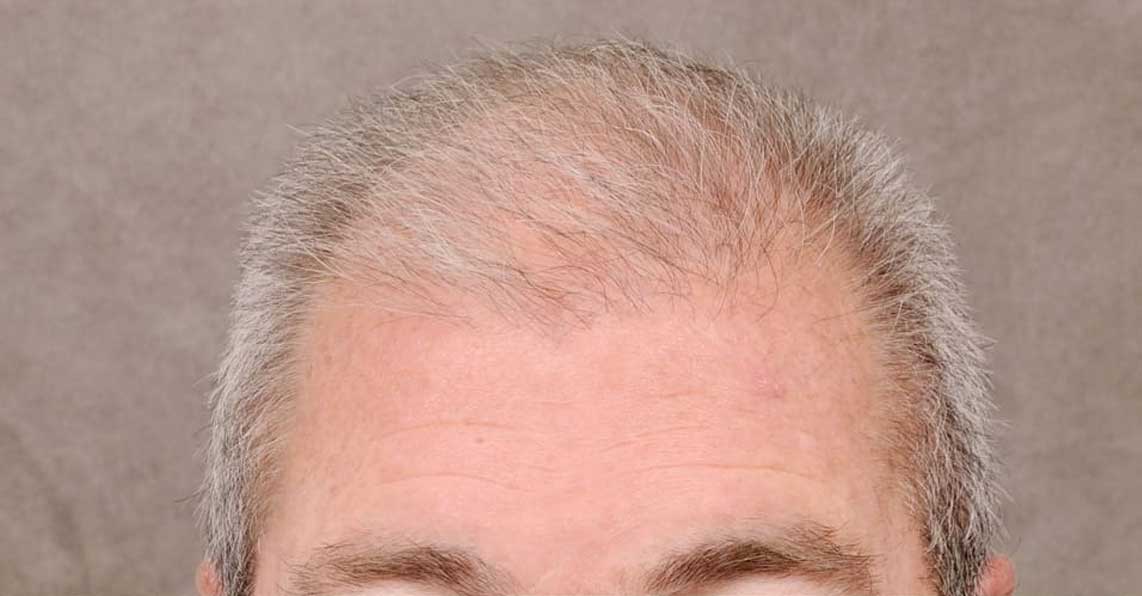 ANTES